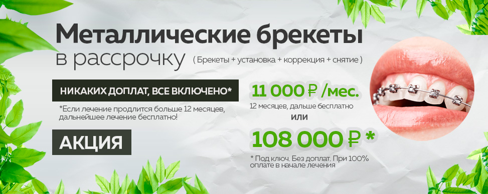 Металлические брекеты под ключ в рассрочку за 11000 рублей в месяц - стоматология Лимон